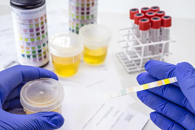 Urinalysis with reagent strips